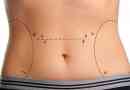 Jak se provádí abdominoplastika břicha?