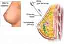 Jak se provádí trepanobiopsie prsu?