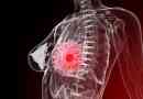 Přehled léčby rakoviny prsu