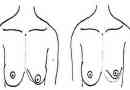 Příčiny asymetrie prsou a bradavek