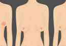 Důvody a způsoby korekce asymetrie prsu