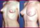 Tubulární prsa: známky anomálie a metody korekce